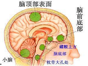 脑肿瘤图片